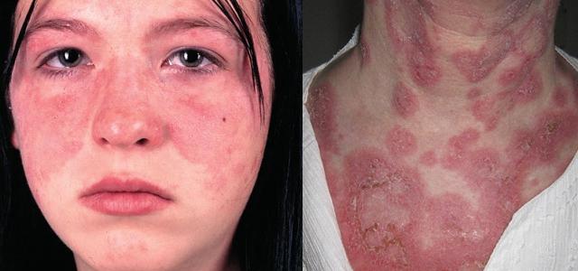 Болит голова все чешется и температура