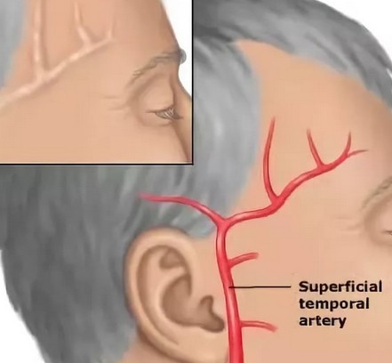 Почему болит правая сторона головы возле виска