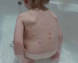 прыщи на спине у детей фото