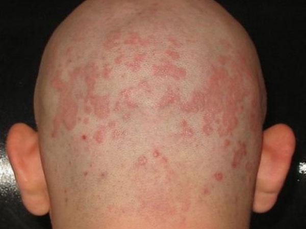 Красное пятнышко на голове болит