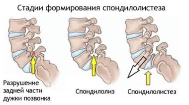 по ночам болит чуть ниже спины