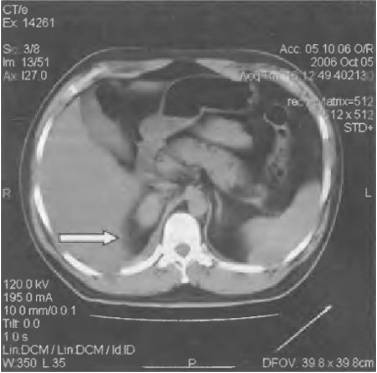 болит постоянно правый бок отдает в спину