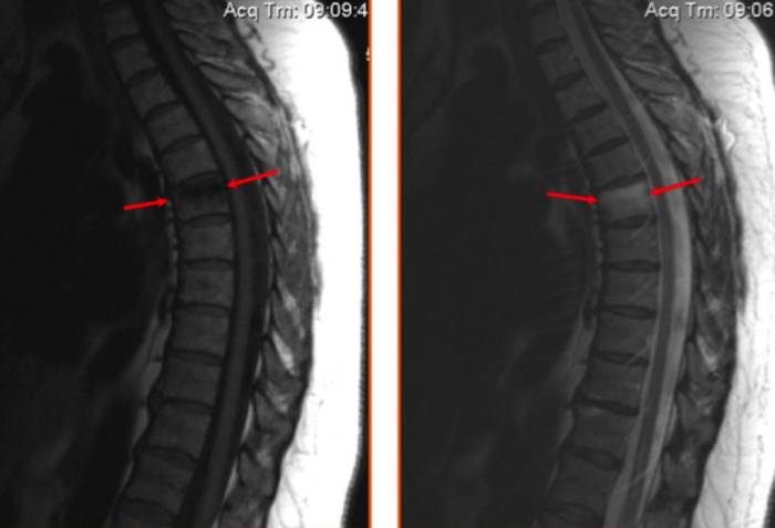 ушиб шестого грудного позвонка МРТ