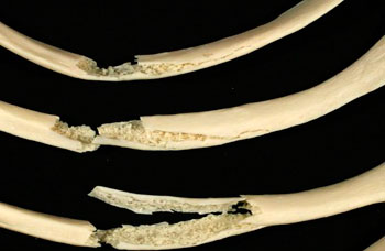 Перелом рёбер