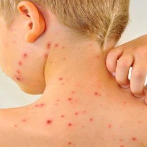 Болит голова все чешется и температура